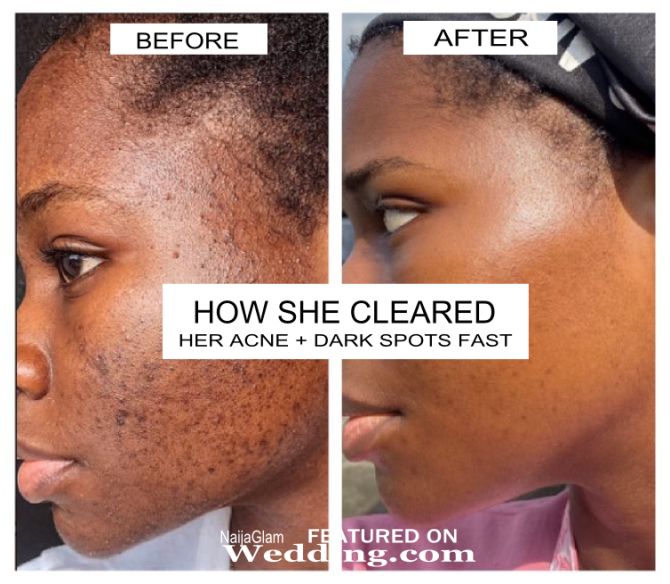 dark spots corrector treatment before after photos